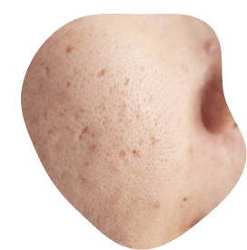 Kulit muka dengan masalah jeragat