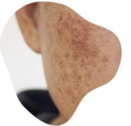 Kulit muka dengan masalah Melasma